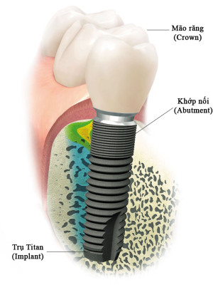Trồng răng Implant có gây hại cho cơ thể không