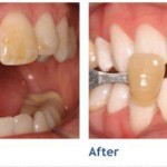 Làm thế nào để khắc phục răng nhiễm màu nặng?