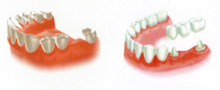 Cấy ghép implant nha khoa