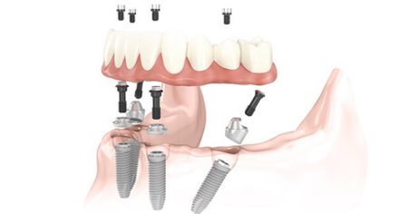 Chăm sóc sau cấy ghép Implant đúng cách