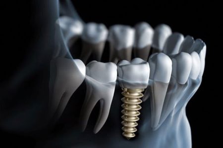 Chăm sóc sau cấy ghép Implant đúng cách