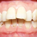 Niềng răng cửa bị lệch có hiệu quả không ?
