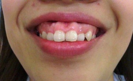 Niềng răng hô có phải nhổ răng không ?