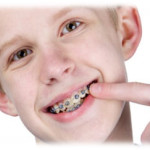 Quy trình niềng răng an toàn bạn nên biết