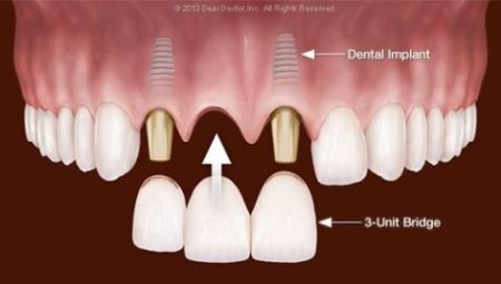 Cấy ghép Implant