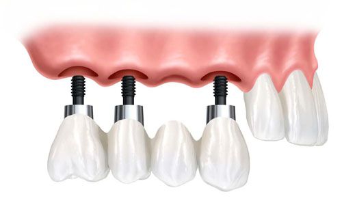 Trồng răng Implant có gây hại cho cơ thể không ?