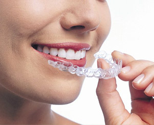 Niềng răng trong suốt bằng nhựa có tốt không?