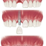 Cấy ghép Implant khi mất một răng