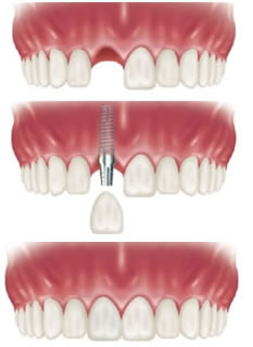 Cấy ghép Implant khi mất một răng