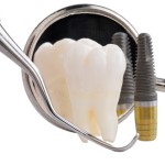 Trồng răng Implant có đau và nguy hiểm không 