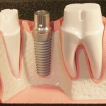 Trồng răng Implant không khó như bạn nghĩ