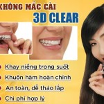 Niềng răng không mắc cài 3D Clear