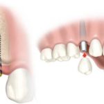 Những lợi ích tuyệt vời mà cấy ghép răng Implant mang lại