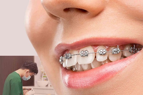 Niềng răng là kỹ thuật tạo ra sự dịch chuyển của răng