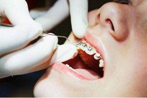 Hạn chế sâu răng