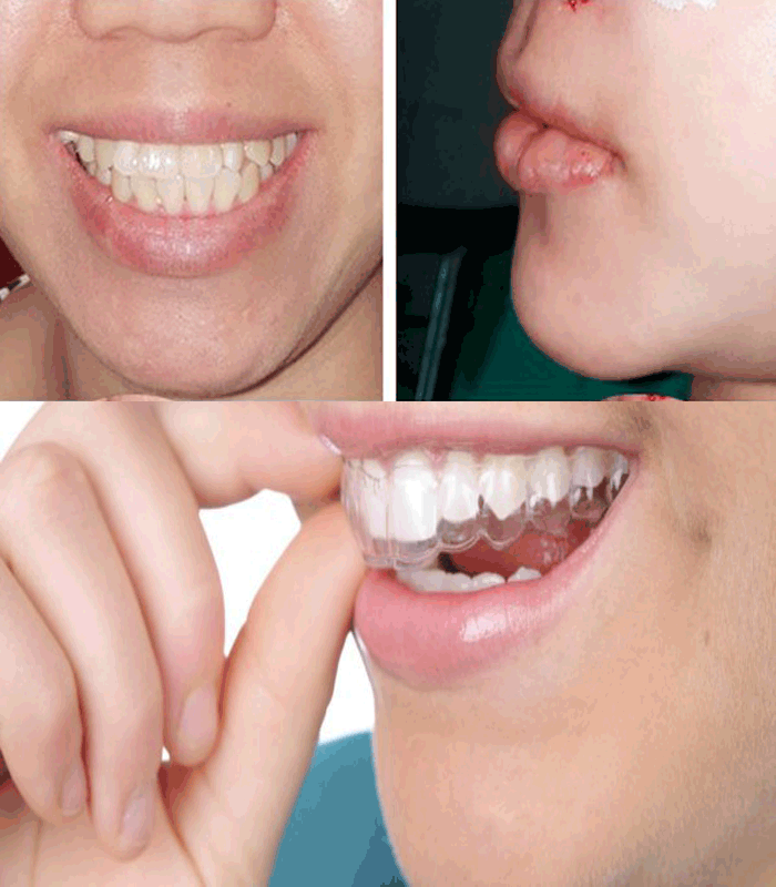phẫu thuật hàm hô móm kết hợp niềng răng 3d CLear