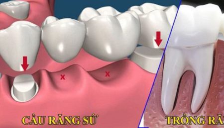 Thông tin liên quan đến vấn đề bọc răng sứ thẩm mỹ