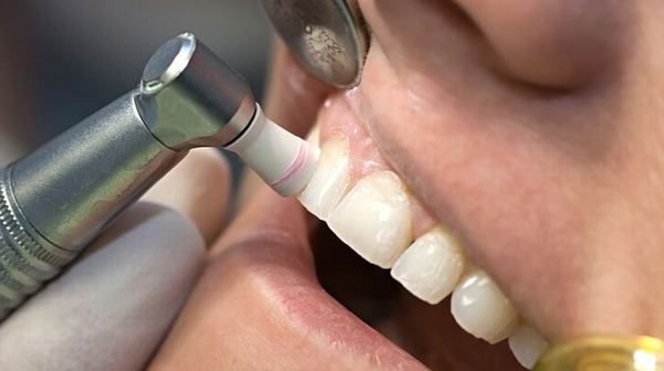 Quá trình cạo vôi răng ngày nay không còn là vấn đề thời gian nữa