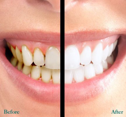 Tẩy trắng răng đem lại hiệu quả như ý