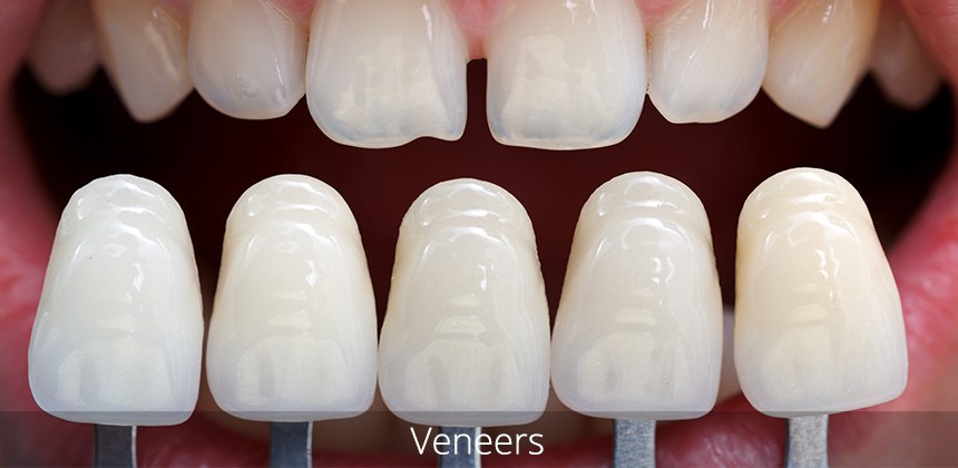 Dán răng sứ veneer giá bao nhiêu phụ thuộc vào nhiều yếu tố