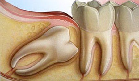Răng khôn mọc lệch gây nhiều biến chứng nguy hiểm