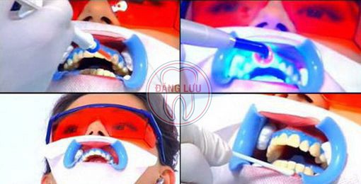Tẩy trắng răng sử dụng Laser Whitening