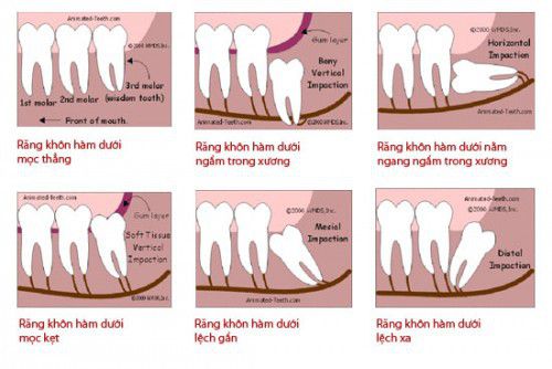 Răng khôn mọc bất thường ảnh hưởng đến các răng lân cận