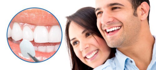 Răng sứ veneer là gì