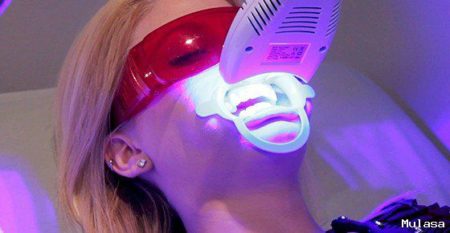 Tẩy trắng răng bằng laser có hại không