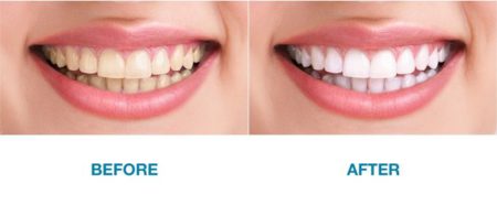 Hình ảnh trước và sau tẩy trắng răng