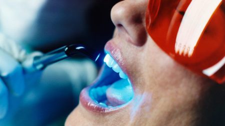 Tẩy trắng răng bằng laser whitening là công nghệ tẩy trắng răng hiện đại