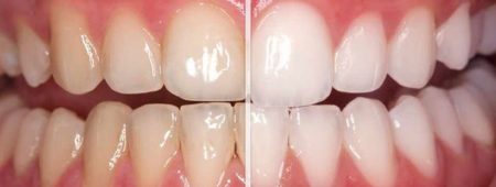 Hình ảnh trước và sau khi tẩy trắng răng