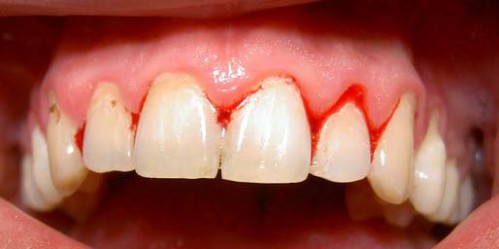 Chảy máu chân răng có nhiều nguyên nhân