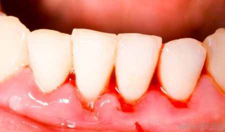 Chảy máu chân răng và cách chữa trị như thế nào?