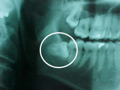 Răng khôn mọc ngầm dễ làm viêm nhiễm và gây hôi miệng