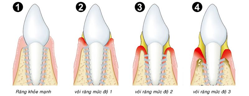 Các mức độ chuyển biến của bệnh viêm chân răng