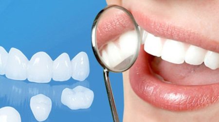 Bọc sứ răng cửa – Những điều bạn cần lưu ý