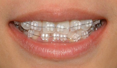 Niềng răng là cách khắc phục hàm hô móm hiệu quả