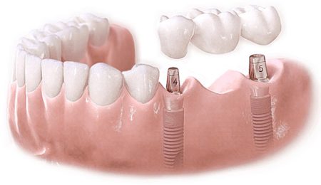 Tổng hợp các loại trụ implant tại nha khoa hiện nay