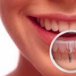 cắm implant răng cửa như thế nào