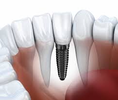 Thời gian cấy ghép răng implant trong bao lâu?