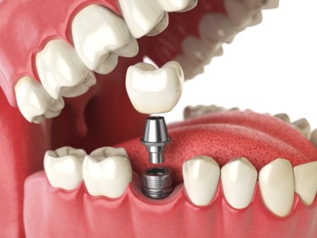 Phục hình răng hàm chắc khỏe chỉ sau 1 lần cấy ghép Implant