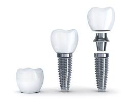 Răng Implant được làm từ chất liệu tiêu chuẩn Y khoa