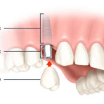 Toàn diện kỹ thuật trồng răng implant