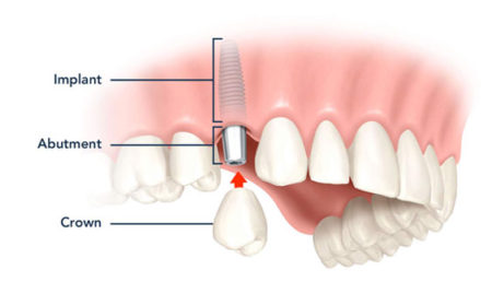 Toàn diện kỹ thuật trồng răng implant