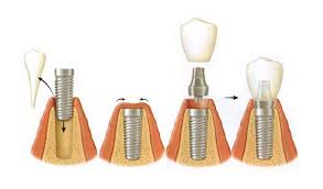 Răng implant ngăn chặn tiêu xương hàm hiệu quả