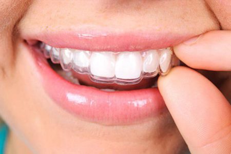 Niềng răng không mắc cài an toàn và hiệu quả