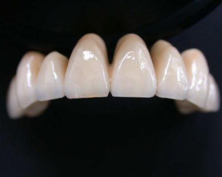 quy trình bọc răng sứ thẩm mỹ