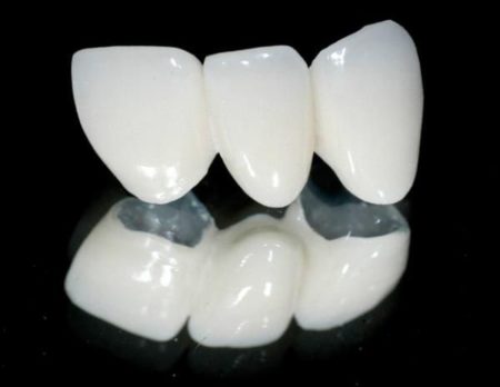 Răng sứ kim loại có độ bền cao