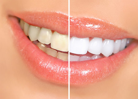Tẩy trắng răng vĩnh viễn có được không?
